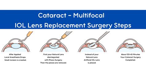 Trifocal Cataract Surgery - Smart Laser Eye Center