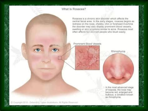 ocular rosacea - pictures, photos