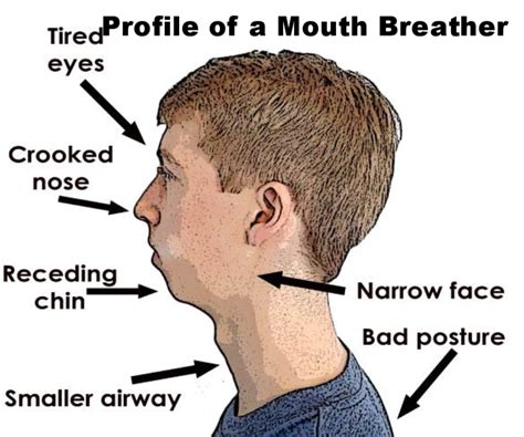 Mouth Breather