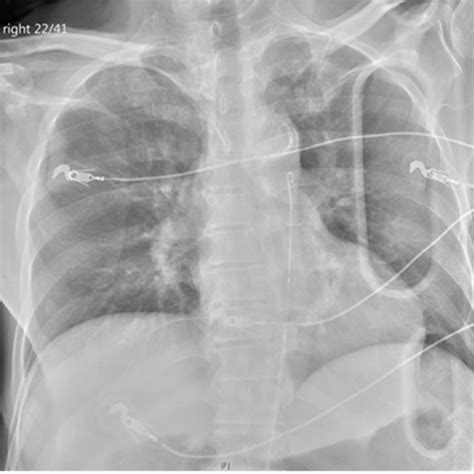 ER-REBOA catheter (Prytime Medical, Boerne TX). A: The "P-tip" on the... | Download Scientific ...