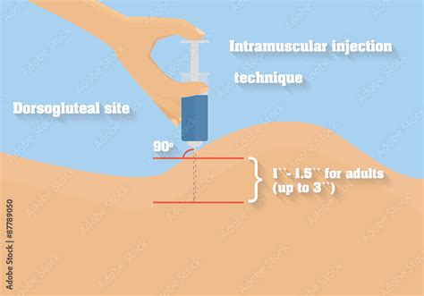 Intramuscular injection technique vector illustration. Angle and depth ...