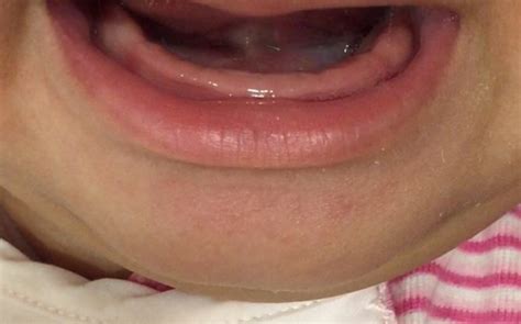 HELP plz! Is my baby geting her molars first? (Photo) | BabyCenter