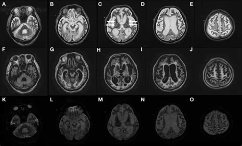 Frontiers | Extensive Delayed Brain Atrophy after Resuscitation in a Patient with Multiple ...