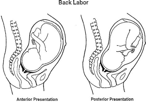 How to turn a posterior baby - Bettina Rae