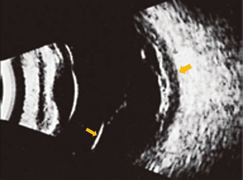 Ultrasound image showing retinal detachment (arrowhead) and choroidal ...