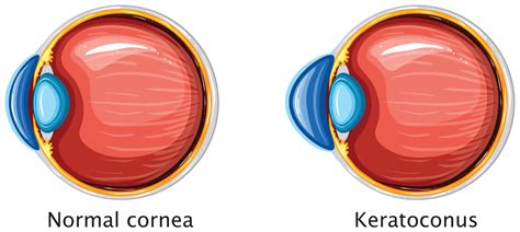 Cornea Beverly Hills | Cornea Cross-Linking Orange County | Gaster Eye