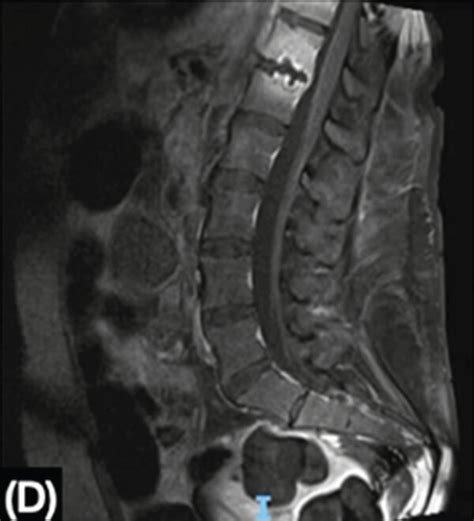 MRI showing the cervical, thoracic, and lumbar spine. (a, b) At the ...