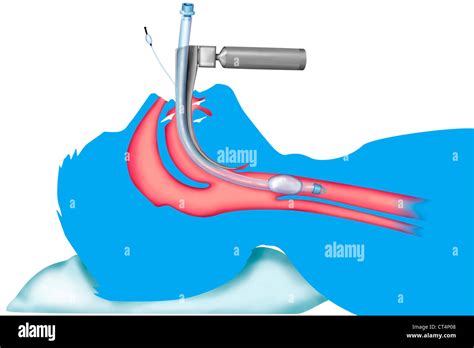 Intubation Materials