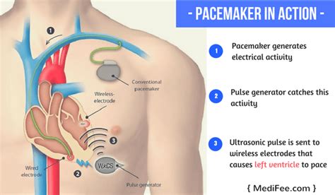 Pacemaker Implantation Surgery