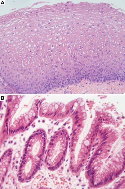 Barretts Esophagus Histology