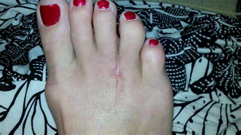 Morton's Neuroma Surgery Recovery: Ten Weeks Post-Op