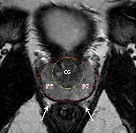 Prostate Gland Anatomy Mri