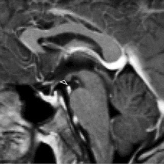 Brain MRI. 3D T1-weighted post-contrast, midsagittal plane. The area ...