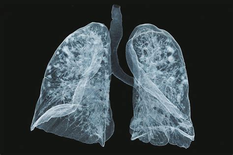 The Truth About COVID Lung | NYU Langone News