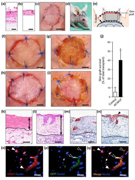 Autologous skin grafting. (a-e) HE-stained sections of a skin graft... | Download Scientific Diagram