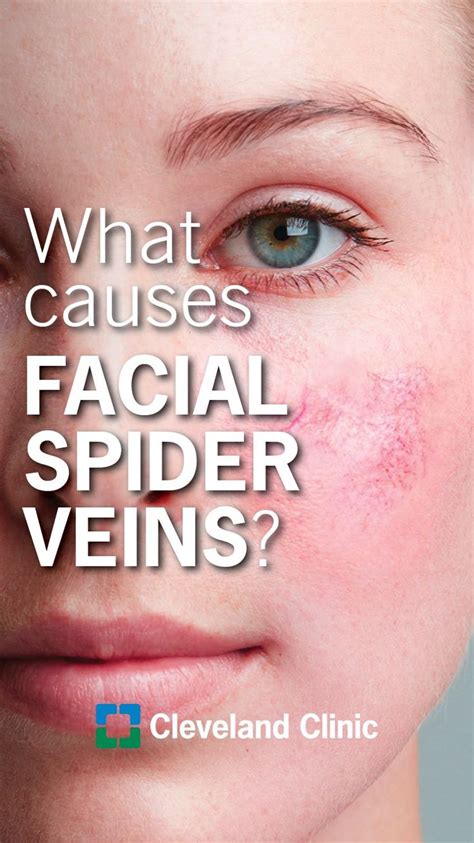 Review Of How To Get Rid Of Spider Veins Under Eyes Naturally 2022