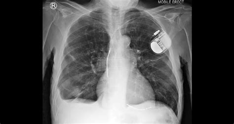 Diaphragmatic Position | Chest X-Ray - MedSchool