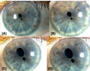 Pupula Duplex | Everything You Need To Know About The Rare Double Pupil Condition