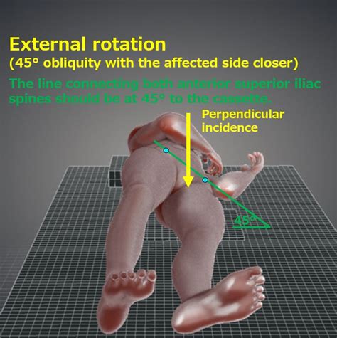 Hip joint oblique view, Judet method, Teufel method, False profile view ...