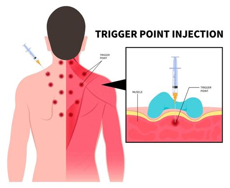 Trigger Point Injections in New Jersey - NJ Pain Care Specialists