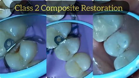 Composite Restoration of Class 2 Cavity in Upper Premolar | Posterior Composite Filling - YouTube