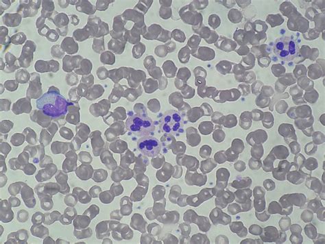 Artifacts in Peripheral Blood Smears - HEMATOLOGY