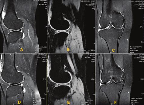 MR images through the right knee joint six months after stem cell... | Download Scientific Diagram