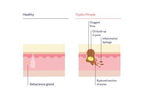 Abscess vs. cyst: what are they? | Curology