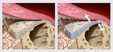 Figure 3 from NeoGen dual texture membrane . The next generation of non ...