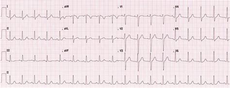 ECG -Normal standardisation with normal sinus rhythm, sinus ...