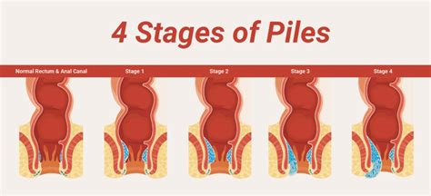 Piles Initial Symptoms