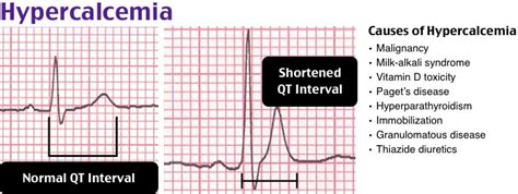 Hypocalcemia Ekg