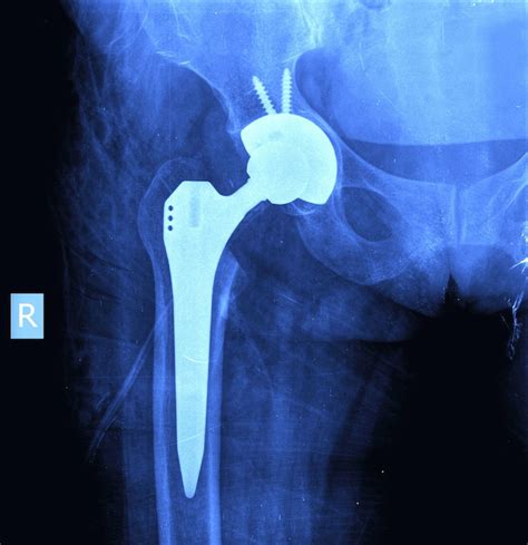 Minimally invasive Anterior Hip arthroplasty | Dr. Michael Serhal