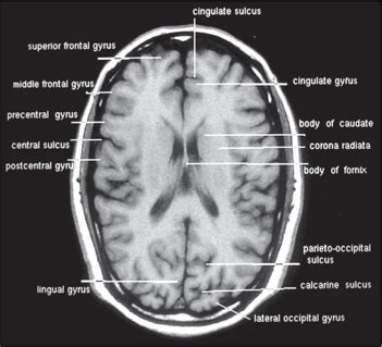 Angular Gyrus Mri