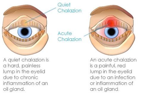 Meibomian Cyst Vs Chalazion