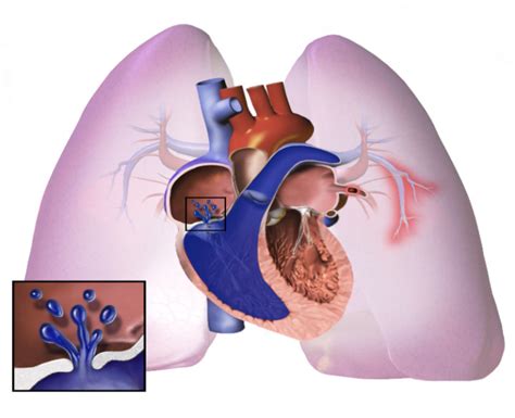 Bayer, Merck get FDA breakthrough status for CTEPH detection software