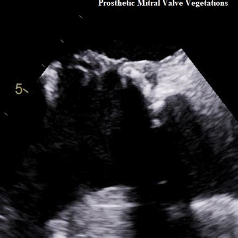 Transesophageal echocardiography showing the prosthetic mitral valve... | Download Scientific ...