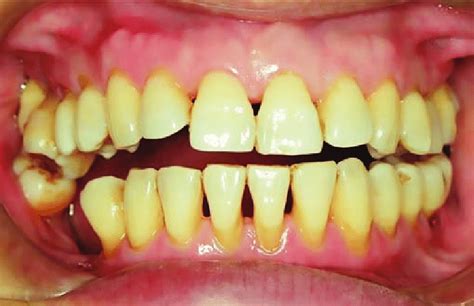 Pretreatment view in centric occlusion showing the extent of the open bite | Download Scientific ...