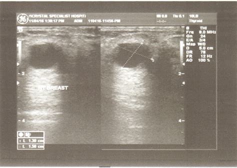 Superficial Galactocelic Progression, Size-Variation and Assessment in a Patient