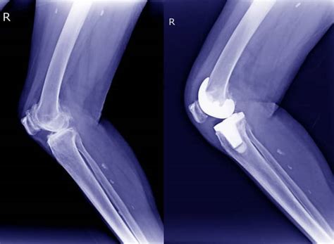 Arthroplasty: Procedure, Risks and Recovery | Dr. Ramakant Kumar