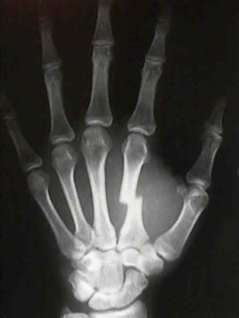 제 2-5 수지 중수골 골절(2nd~5th metacarpal fracture) : 손바닥에 큰 충격을 받고 중수골이 부러졌어요 ...