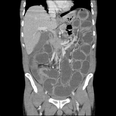 53 Intestine: Tuberculosis | Maude Abbott Medical Museum - McGill University