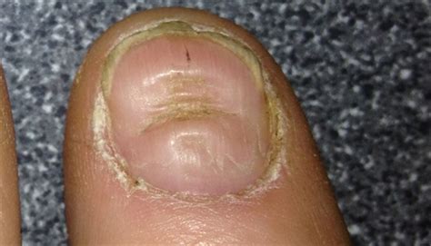 Derm Dx: Severe ridging along the nails - Clinical Advisor