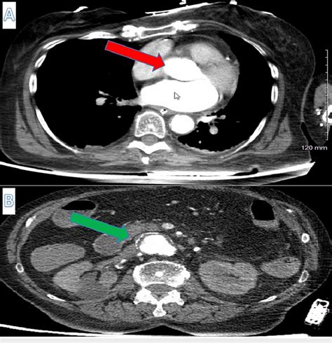 Computed tomography angiogram (CTA) chest and CTA abdomen and pelvis of... | Download Scientific ...