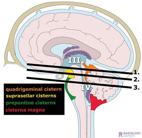 CT brain hemorrhage