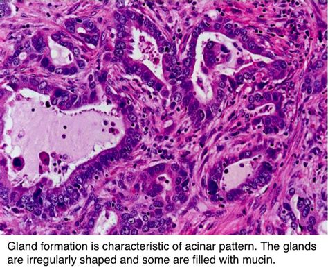 Pathology Outlines - Adenocarcinoma overview