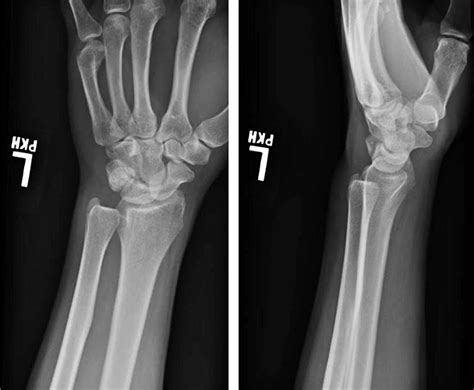 Cureus | Isolated Volar Dislocation of the Distal Radioulnar Joint Treated With Successful ...