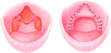 Uvulopalatal flap is a modification of uvulopharyngoplasty. Instead of... | Download Scientific ...