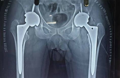 Bilateral hip avascular necrosis patient- operated bilateral total hip replacement in Indore ...