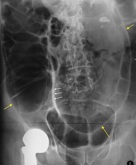 Sigmoid volvulus - Radiology at St. Vincent's University Hospital